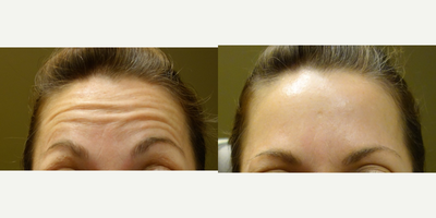 Botox before and after photo