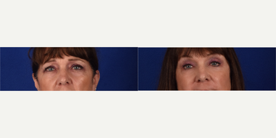 Eyelid Surgery before and after photo