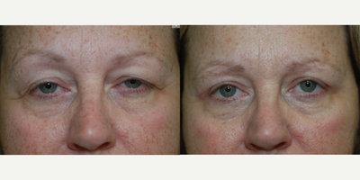 Eyelid Surgery before and after photo