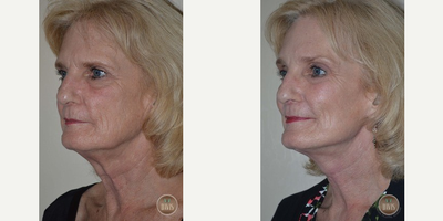 Facelift before and after photo