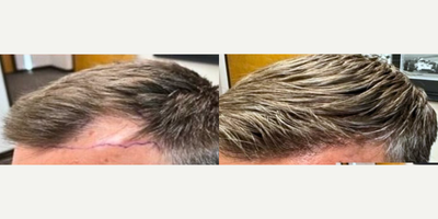 FUE Hair Transplant before and after photo