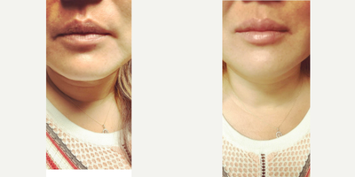 Lip Fillers before and after photo