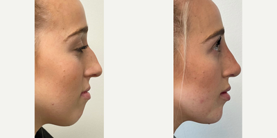 Nonsurgical Nose Job before and after photo