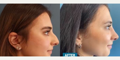 Rhinoplasty before and after photo