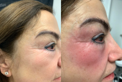 TempSure Envi before and after photo