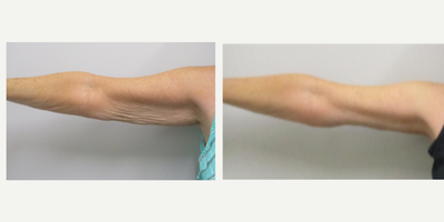 Arm Lift before and after photo