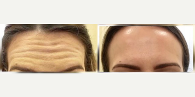 Botox before and after photo