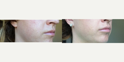 Dermal Fillers before and after photo