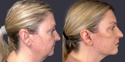 Facelift before and after photo
