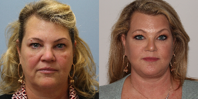 Rhinoplasty before and after photo