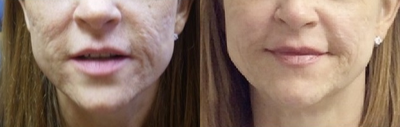 CO2 Laser before and after photo