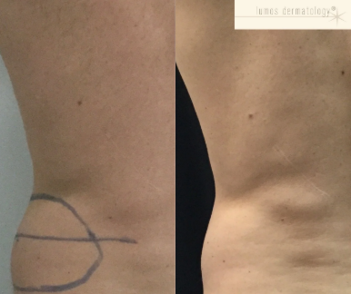 CoolSculpting before and after photo