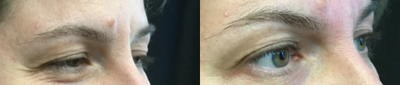 Dermal Fillers before and after photo