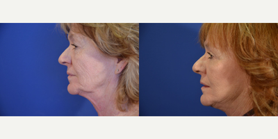 Facelift before and after photo