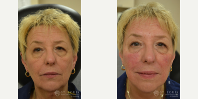 Juvederm before and after photo