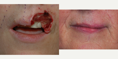 Lip Surgery before and after photo