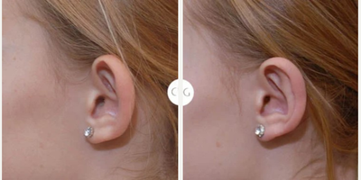 Ear Surgery before and after photo