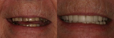 Smile Makeover before and after photo