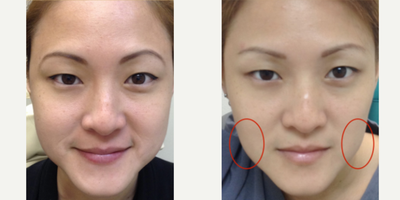 Botox for TMJ before and after photo