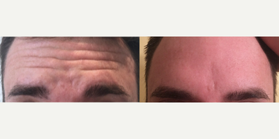 Botox before and after photo