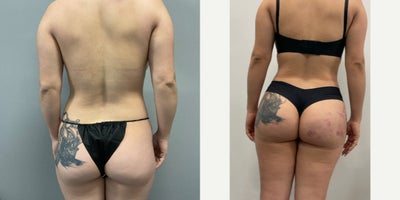 Brazilian Butt Lift before and after photo