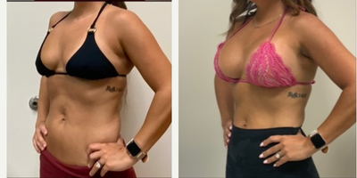 Breast Augmentation before and after photo