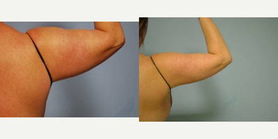 Liposuction before and after photo
