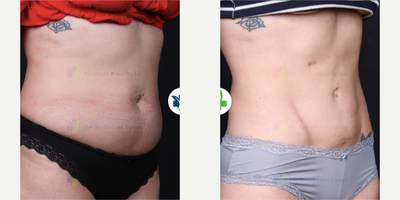 Liposuction before and after photo