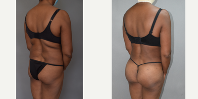 Brazilian Butt Lift before and after photo