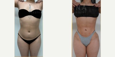 Brazilian Butt Lift before and after photo