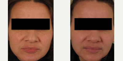 Laser Resurfacing before and after photo