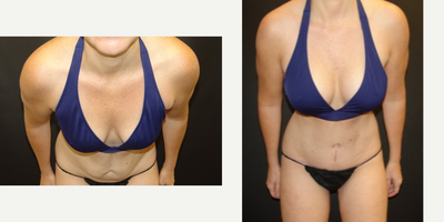 Mommy Makeover before and after photo