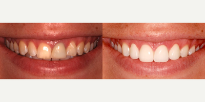 Porcelain Veneers before and after photo