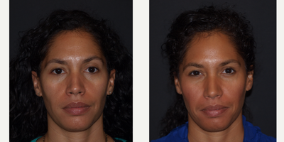 Restylane before and after photo