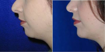 Chin Implant before and after photo