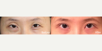Double Eyelid Surgery before and after photo