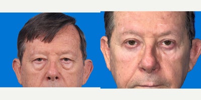 Eyelid Surgery before and after photo