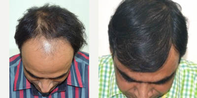 Hair Loss Treatment before and after photo