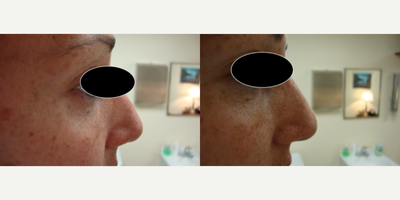 Nonsurgical Nose Job before and after photo