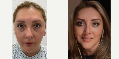 Rhinoplasty before and after photo