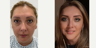 Rhinoplasty before and after photo