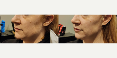 Cheek Fillers before and after photo
