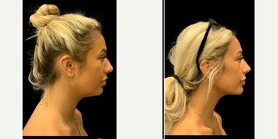 Chin Liposuction before and after photo