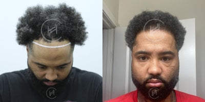 FUE Hair Transplant before and after photo