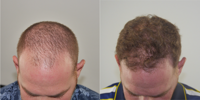 Hair Transplant before and after photo