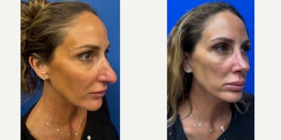 Rhinoplasty before and after photo