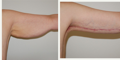 Arm Lift before and after photo