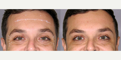 Botox before and after photo