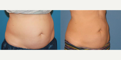 CoolSculpting before and after photo