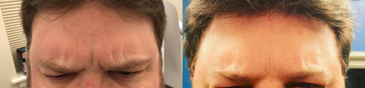 Dysport before and after photo
